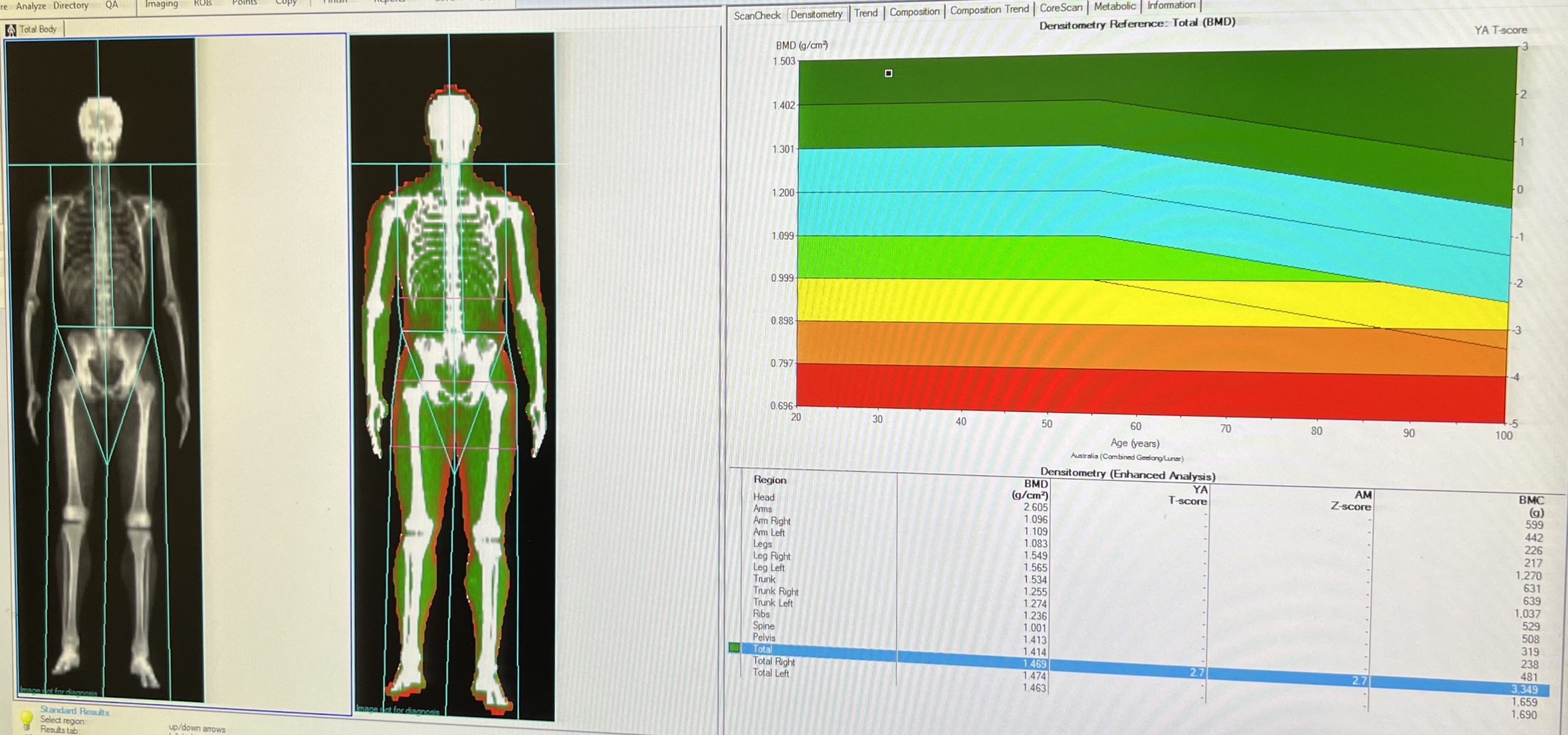 dexa scan bone density results