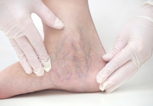 sclerotherapy