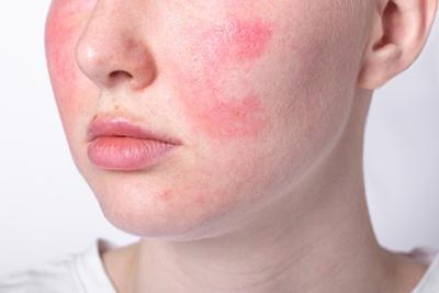 rosacea treatment